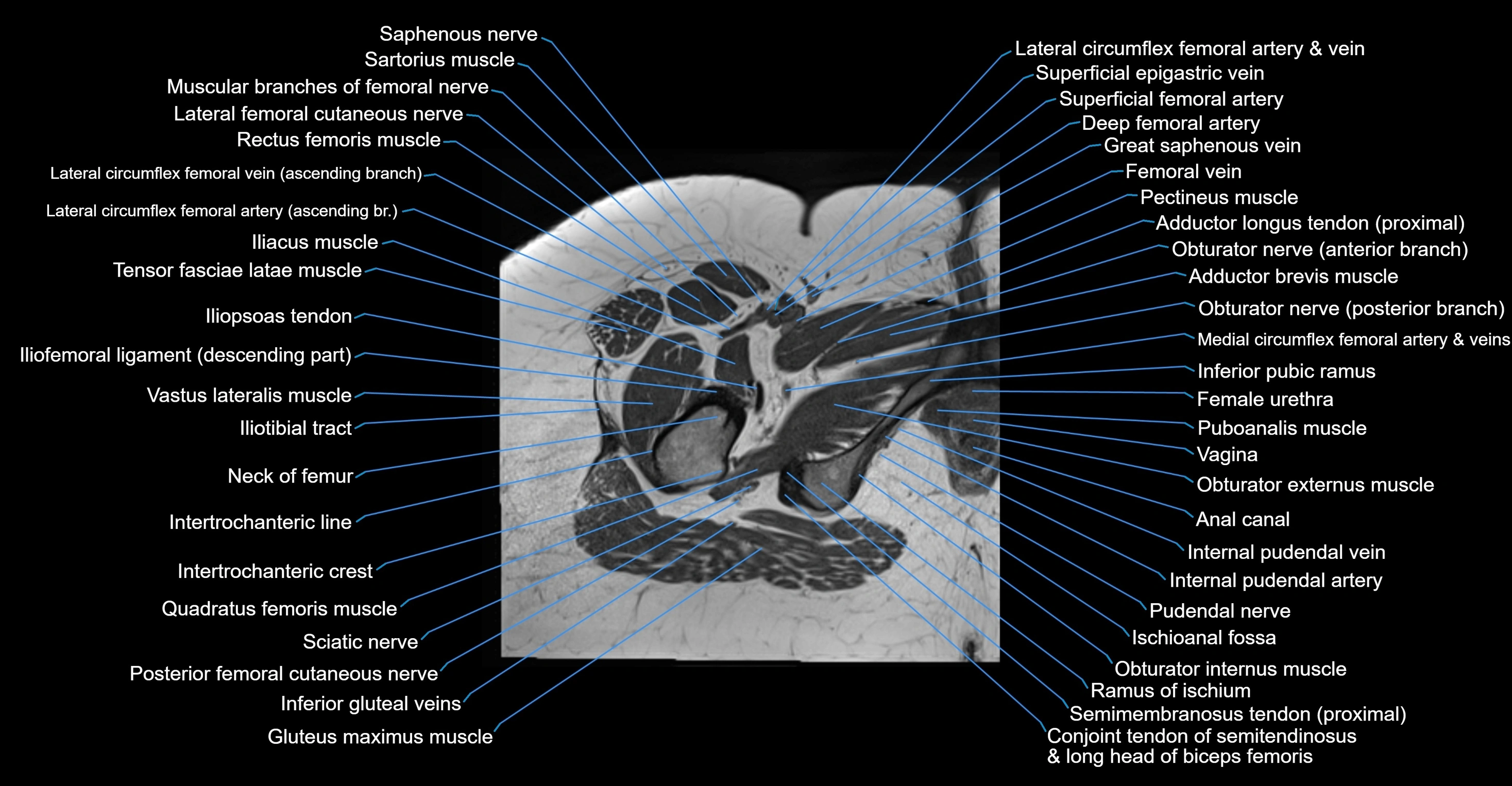 MRI hip axial cross sectional anatomy 3T 3D  radiology  anatomy image-img-00001-00060.webp